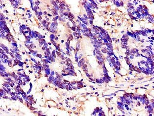 Immunohistochemistry of paraffin-embedded human colon cancer using CSB-PA024067LA01HU at dilution of 1:100 Immunohistochemistry of paraffin-embedded human colon cancer using CSB-PA024067LA01HU at dilution of 1:100