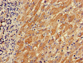 Immunohistochemistry of paraffin-embedded human liver cancer using CSB-PA024106LA01HU at dilution of 1:100 Immunohistochemistry of paraffin-embedded human liver cancer using CSB-PA024106LA01HU at dilution of 1:100
