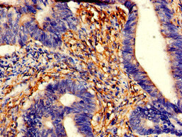 Immunohistochemistry of paraffin-embedded human colon cancer using CSB-PA024106LA01HU at dilution of 1:100