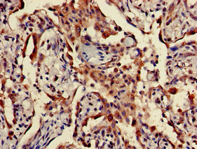 Immunohistochemistry of paraffin-embedded human lung cancer using CSB-PA024132LA01HU at dilution of 1:100 Immunohistochemistry of paraffin-embedded human lung cancer using CSB-PA024132LA01HU at dilution of 1:100