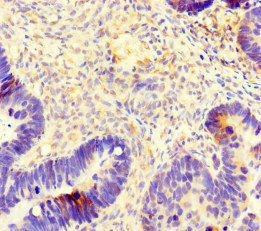 Immunohistochemistry of paraffin-embedded human ovarian cancer using CSB-PA025324LA01HU at dilution of 1:100