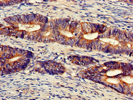 Immunohistochemistry of paraffin-embedded human colon cancer using CSB-PA025560LA01HU at dilution of 1:100 Immunohistochemistry of paraffin-embedded human colon cancer using CSB-PA025560LA01HU at dilution of 1:100