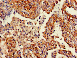 Immunohistochemistry of paraffin-embedded human lung cancer using CSB-PA026138LA01HU at dilution of 1:100