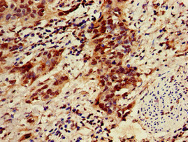 Immunohistochemistry of paraffin-embedded human bladder cancer using CSB-PA026957LA01HU at dilution of 1:100