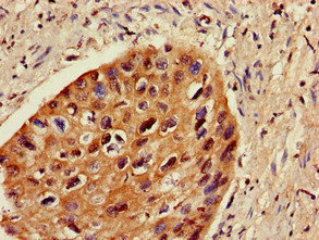 Immunohistochemistry of paraffin-embedded human cervical cancer using CSB-PA026957LA01HU at dilution of 1:100