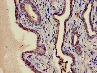 Immunohistochemistry of paraffin-embedded human prostate cancer using CSB-PA02959A0Rb at dilution of 1:100 Immunohistochemistry of paraffin-embedded human prostate cancer using CSB-PA02959A0Rb at dilution of 1:100