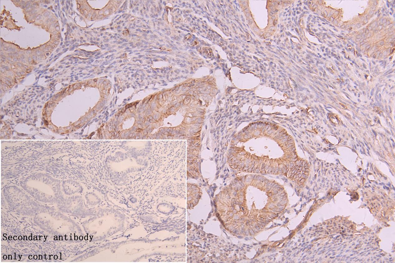 Immunohistochemistry of paraffin-embedded human breast cancer tissue using CSB-PA10559A0Rb at dilution of 1:300