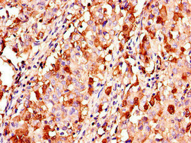 Immunohistochemistry of paraffin-embedded human lung cancer using CSB-PA12729A0Rb at dilution of 1:100