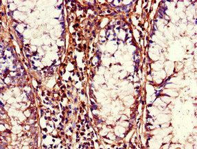 Immunohistochemistry of paraffin-embedded human colon cancer using CSB-PA613684LA01HU at dilution of 1:100