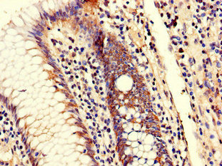 Immunohistochemistry of paraffin-embedded human colon cancer using CSB-PA617909LA01HU at dilution of 1:100
