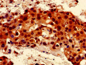 Immunohistochemistry of paraffin-embedded human breast cancer using CSB-PA618981LA01HU at dilution of 1:100