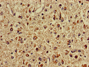Immunohistochemistry of paraffin-embedded human glioma using CSB-PA623101LA01HU at dilution of 1:100