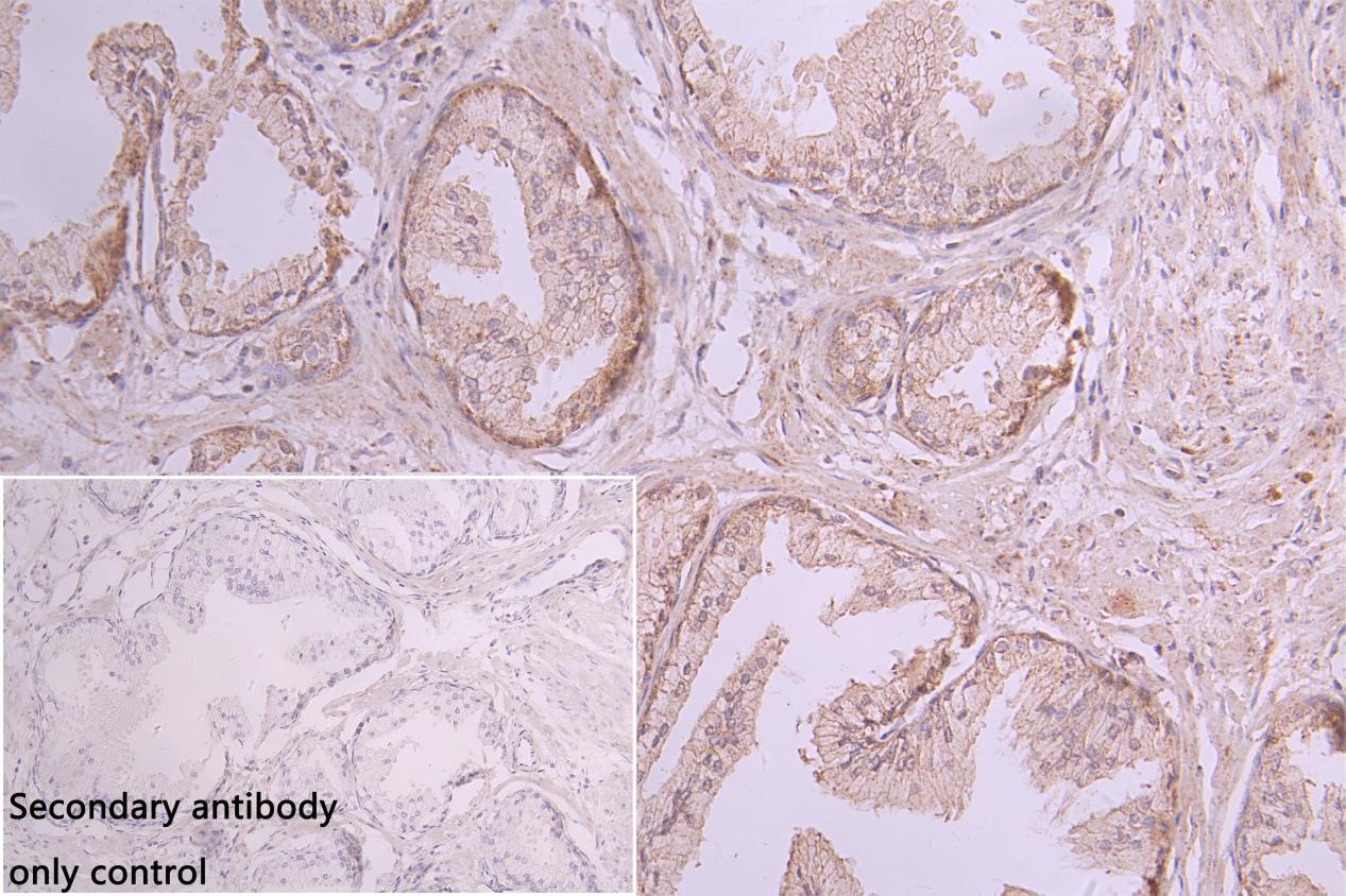 Immunohistochemistry of paraffin-embedded human melanoma using CSB-PA737873LA01HU at dilution of 1:100