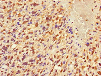 Immunohistochemistry of paraffin-embedded human glioma using CSB-PA773602LA01HU at dilution of 1:100