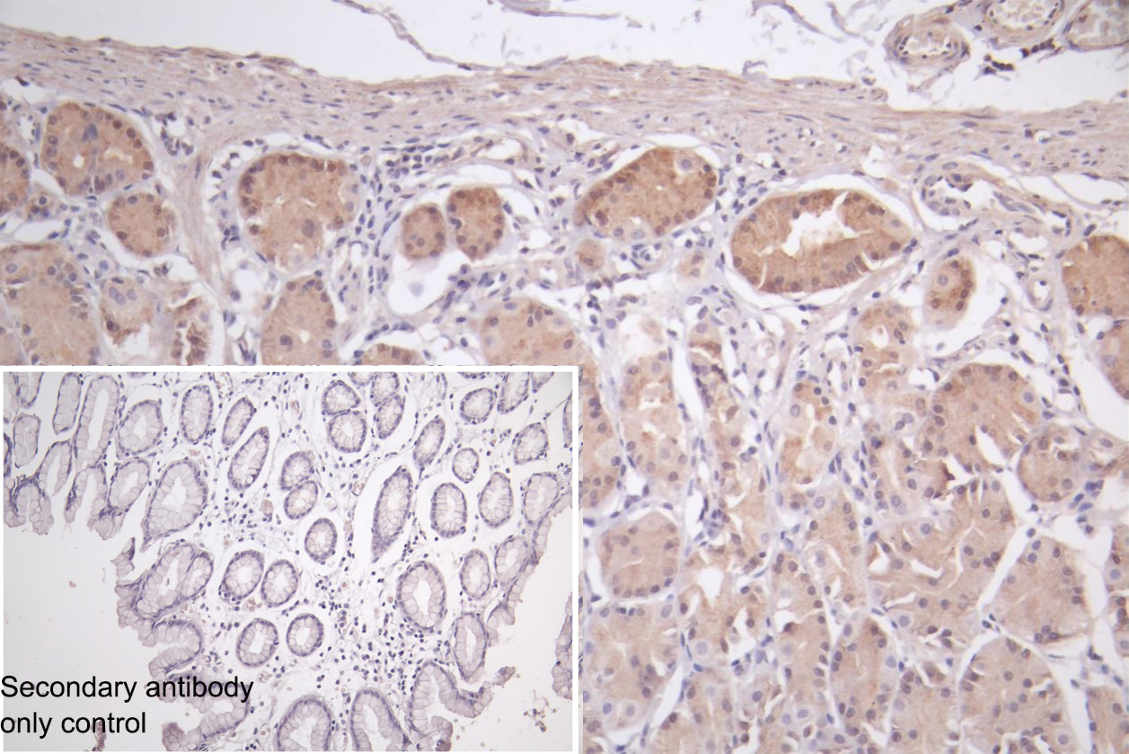 Immunohistochemistry of paraffin-embedded human glioma using CSB-PA816886LA01HU at dilution of 1:100