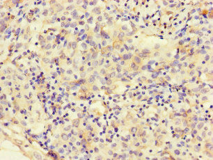 Immunohistochemistry of paraffin-embedded human lung cancer using CSB-PA822242LA01HU at dilution of 1:100 Immunohistochemistry of paraffin-embedded human lung cancer using CSB-PA822242LA01HU at dilution of 1:100