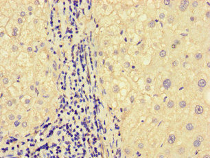 Immunohistochemistry of paraffin-embedded human liver cancer using CSB-PA822242LA01HU at dilution of 1:100