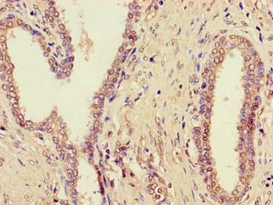 Immunohistochemistry of paraffin-embedded human prostate cancer using CSB-PA837848LA01HU at dilution of 1:100