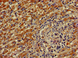 Immunohistochemistry of paraffin-embedded human liver cancer using CSB-PA856900LA01HU at dilution of 1:100