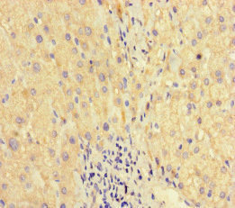 Immunohistochemistry of paraffin-embedded human liver cancer using CSB-PA861133HA01HU at dilution of 1:100