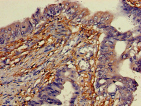 Immunohistochemistry of paraffin-embedded human colon cancer using CSB-PA863928LA01HU at dilution of 1:100