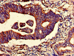 Immunohistochemistry of paraffin-embedded human colon cancer using CSB-PA866336LA01HU at dilution of 1:100