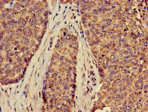 Immunohistochemistry of paraffin-embedded human ovarian cancer using CSB-PA873638LA01HU at dilution of 1:100