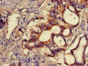 Immunohistochemistry of paraffin-embedded human colon cancer using CSB-PA882091LA01HU at dilution of 1:100 Immunohistochemistry of paraffin-embedded human colon cancer using CSB-PA882091LA01HU at dilution of 1:100