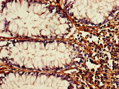 IHC image of CSB-PA002288HA01HU diluted at 1:1200 and staining in paraffin-embedded human colon cancer performed on a Leica BondTM system. After dewaxing and hydration, antigen retrieval was mediated by high pressure in a citrate buffer (pH 6.0). Section was blocked with 10% normal goat serum 30min at RT. Then primary antibody (1% BSA) was incubated at 4°C overnight. The primary is detected by a biotinylated secondary antibody and visualized using an HRP conjugated SP system.