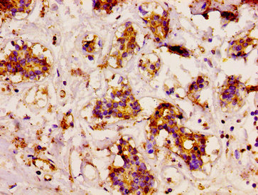 IHC image of CSB-PA004932LA01HU diluted at 1:200 and staining in paraffin-embedded human breast cancer performed on a Leica BondTM system. After dewaxing and hydration, antigen retrieval was mediated by high pressure in a citrate buffer (pH 6.0). Section was blocked with 10% normal goat serum 30min at RT. Then primary antibody (1% BSA) was incubated at 4°C overnight. The primary is detected by a biotinylated secondary antibody and visualized using an HRP conjugated SP system.