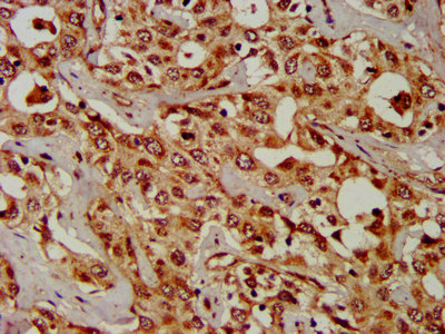 IHC image of CSB-PA005913LA01HU diluted at 1:300 and staining in paraffin-embedded human liver cancer performed on a Leica BondTM system. After dewaxing and hydration, antigen retrieval was mediated by high pressure in a citrate buffer (pH 6.0). Section was blocked with 10% normal goat serum 30min at RT. Then primary antibody (1% BSA) was incubated at 4°C overnight. The primary is detected by a biotinylated secondary antibody and visualized using an HRP conjugated SP system.