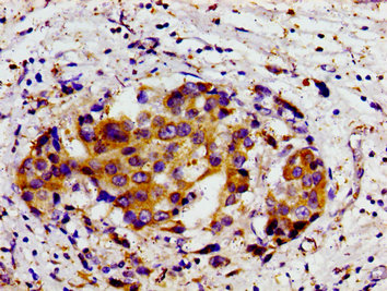 Immunohistochemistry of paraffin-embedded human breast cancer using CSB-PA006852LA01HU at dilution of 1:100