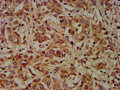 IHC image of CSB-PA006963LA01HU diluted at 1:200 and staining in paraffin-embedded human liver cancer performed on a Leica BondTM system. After dewaxing and hydration, antigen retrieval was mediated by high pressure in a citrate buffer (pH 6.0). Section was blocked with 10% normal goat serum 30min at RT. Then primary antibody (1% BSA) was incubated at 4°C overnight. The primary is detected by a biotinylated secondary antibody and visualized using an HRP conjugated SP system.