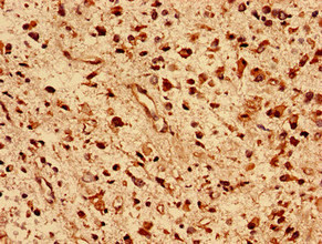 Immunohistochemistry analysis of human glioma using CSB-PA007011LA01HU at dilution of 1:100