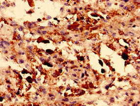 Immunohistochemistry analysis of human melanoma using CSB-PA007779LA01HU at dilution of 1:100