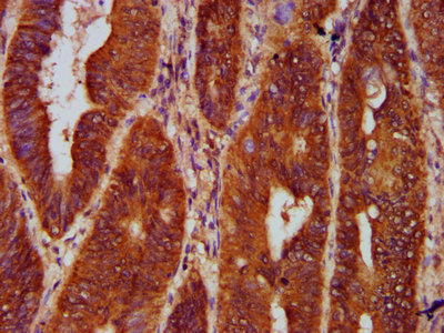 IHC image of CSB-PA009716LA01HU diluted at 1:300 and staining in paraffin-embedded human colon cancer performed on a Leica BondTM system. After dewaxing and hydration, antigen retrieval was mediated by high pressure in a citrate buffer (pH 6.0). Section was blocked with 10% normal goat serum 30min at RT. Then primary antibody (1% BSA) was incubated at 4°C overnight. The primary is detected by a biotinylated secondary antibody and visualized using an HRP conjugated SP system.