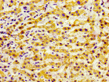 Immunohistochemistry of paraffin-embedded human liver cancer using CSB-PA009926LA01HU at dilution of 1:100