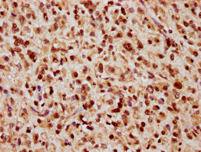 IHC image of CSB-PA010389OA09nbhbHU diluted at 1:20 and staining in paraffin-embedded human glioma performed on a Leica BondTM system. After dewaxing and hydration, antigen retrieval was mediated by high pressure in a citrate buffer (pH 6.0). Section was blocked with 10% normal goat serum 30min at RT. Then primary antibody (1% BSA) was incubated at 4°C overnight. The primary is detected by a biotinylated secondary antibody and visualized using an HRP conjugated SP system. IHC image of CSB-PA010389OA09nbhbHU diluted at 1:20 and staining in paraffin-embedded human glioma performed on a Leica BondTM system. After dewaxing and hydration, antigen retrieval was mediated by high pressure in a citrate buffer (pH 6.0). Section was blocked with 10% normal goat serum 30min at RT. Then primary antibody (1% BSA) was incubated at 4°C overnight. The primary is detected by a biotinylated secondary antibody and visualized using an HRP conjugated SP system.