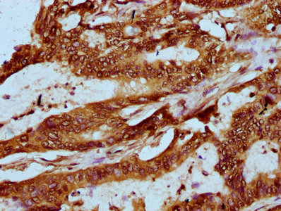 IHC image of CSB-PA010389OA118nforHU diluted at 1:20 and staining in paraffin-embedded human colon cancer performed on a Leica BondTM system. After dewaxing and hydration, antigen retrieval was mediated by high pressure in a citrate buffer (pH 6.0). Section was blocked with 10% normal goat serum 30min at RT. Then primary antibody (1% BSA) was incubated at 4°C overnight. The primary is detected by a biotinylated secondary antibody and visualized using an HRP conjugated SP system.