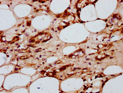IHC image of CSB-PA010389OA118nforHU diluted at 1:20 and staining in paraffin-embedded human breast cancer performed on a Leica BondTM system. After dewaxing and hydration, antigen retrieval was mediated by high pressure in a citrate buffer (pH 6.0). Section was blocked with 10% normal goat serum 30min at RT. Then primary antibody (1% BSA) was incubated at 4°C overnight. The primary is detected by a biotinylated secondary antibody and visualized using an HRP conjugated SP system.
