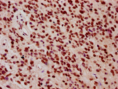 IHC image of CSB-PA010418OA09ncrHU diluted at 1:10 and staining in paraffin-embedded human glioma performed on a Leica BondTM system. After dewaxing and hydration, antigen retrieval was mediated by high pressure in a citrate buffer (pH 6.0). Section was blocked with 10% normal goat serum 30min at RT. Then primary antibody (1% BSA) was incubated at 4°C overnight. The primary is detected by a biotinylated secondary antibody and visualized using an HRP conjugated SP system.