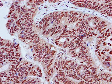 Immunohistochemistry of paraffin-embedded human colon cancer using CSB-PA010418OA27nme3HU at dilution of 1:100