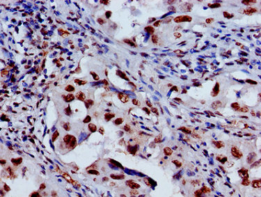 Immunohistochemistry of paraffin-embedded human lung cancer using CSB-PA010418OA27nme3HU at dilution of 1:100