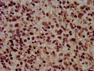 IHC image of CSB-PA010418OA45nphHU diluted at 1:100 and staining in paraffin-embedded human glioma performed on a Leica BondTM system. After dewaxing and hydration, antigen retrieval was mediated by high pressure in a citrate buffer (pH 6.0). Section was blocked with 10% normal goat serum 30min at RT. Then primary antibody (1% BSA) was incubated at 4°C overnight. The primary is detected by a biotinylated secondary antibody and visualized using an HRP conjugated SP system.