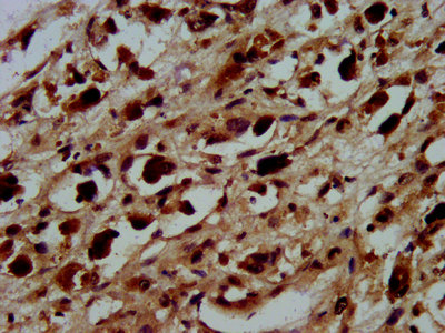 IHC image of CSB-PA010418OA45nphHU diluted at 1:100 and staining in paraffin-embedded human melanoma performed on a Leica BondTM system. After dewaxing and hydration, antigen retrieval was mediated by high pressure in a citrate buffer (pH 6.0). Section was blocked with 10% normal goat serum 30min at RT. Then primary antibody (1% BSA) was incubated at 4°C overnight. The primary is detected by a biotinylated secondary antibody and visualized using an HRP conjugated SP system.