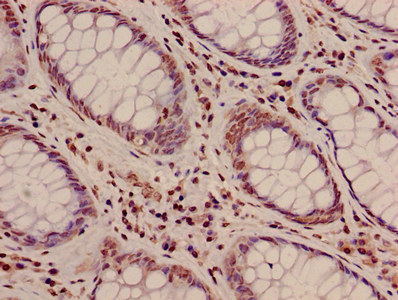 Immunohistochemistry of paraffin-embedded human colon cancer using CSB-PA010418PA10nphHU at dilution of 1:100