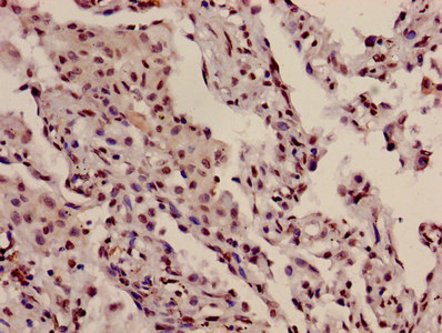 Immunohistochemistry of paraffin-embedded human lung cancer using CSB-PA010418PA10nphHU at dilution of 1:100