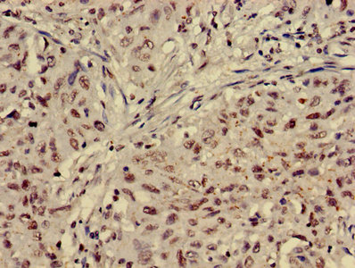 Immunohistochemistry of paraffin-embedded human lung cancer using CSB-PA010429OA05nacHU at dilution of 1:100