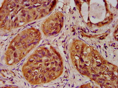 IHC image of CSB-PA010429OA20nme3HU diluted at 1:100 and staining in paraffin-embedded human cervical cancer performed on a Leica BondTM system. After dewaxing and hydration, antigen retrieval was mediated by high pressure in a citrate buffer (pH 6.0). Section was blocked with 10% normal goat serum 30min at RT. Then primary antibody (1% BSA) was incubated at 4°C overnight. The primary is detected by a biotinylated secondary antibody and visualized using an HRP conjugated SP system. IHC image of CSB-PA010429OA20nme3HU diluted at 1:100 and staining in paraffin-embedded human cervical cancer performed on a Leica BondTM system. After dewaxing and hydration, antigen retrieval was mediated by high pressure in a citrate buffer (pH 6.0). Section was blocked with 10% normal goat serum 30min at RT. Then primary antibody (1% BSA) was incubated at 4°C overnight. The primary is detected by a biotinylated secondary antibody and visualized using an HRP conjugated SP system.