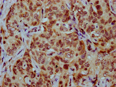 IHC image of CSB-PA010429OA77nsucHU diluted at 1:20 and staining in paraffin-embedded human liver cancer performed on a Leica BondTM system. After dewaxing and hydration, antigen retrieval was mediated by high pressure in a citrate buffer (pH 6.0). Section was blocked with 10% normal goat serum 30min at RT. Then primary antibody (1% BSA) was incubated at 4°C overnight. The primary is detected by a biotinylated secondary antibody and visualized using an HRP conjugated SP system. IHC image of CSB-PA010429OA77nsucHU diluted at 1:20 and staining in paraffin-embedded human liver cancer performed on a Leica BondTM system. After dewaxing and hydration, antigen retrieval was mediated by high pressure in a citrate buffer (pH 6.0). Section was blocked with 10% normal goat serum 30min at RT. Then primary antibody (1% BSA) was incubated at 4°C overnight. The primary is detected by a biotinylated secondary antibody and visualized using an HRP conjugated SP system.